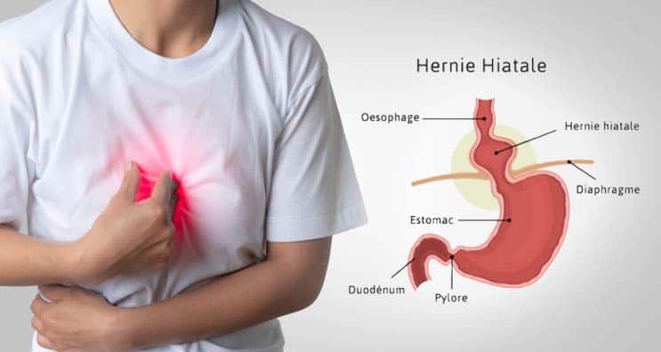 hernie hiatale causes symptômes diagnostic traitement